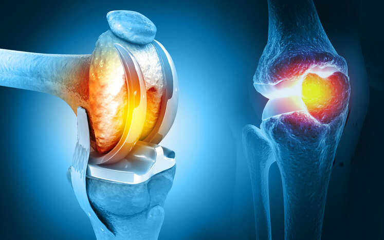 Human Knee Replacement Surgery Illustration