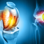 Human Knee Replacement Surgery Illustration