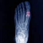 Xray foot stress fracture