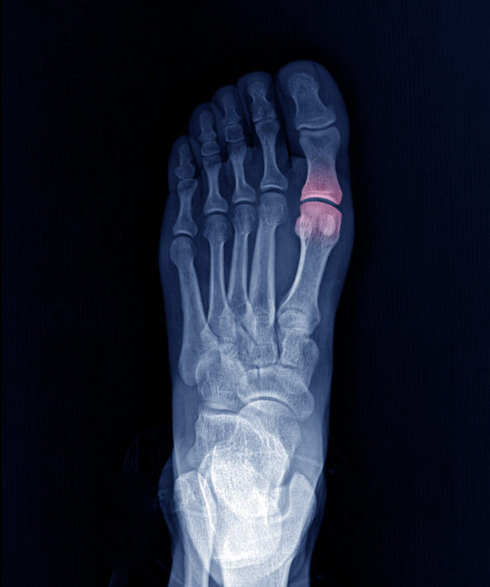 Xray foot stress fracture